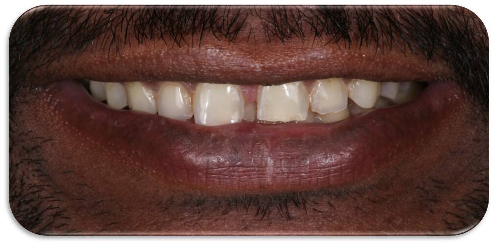 Tiny Pearls Dental Care - Pre - Operative