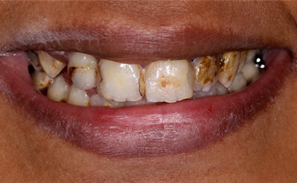 Tiny Pearls Dental Care - Pre - Operative